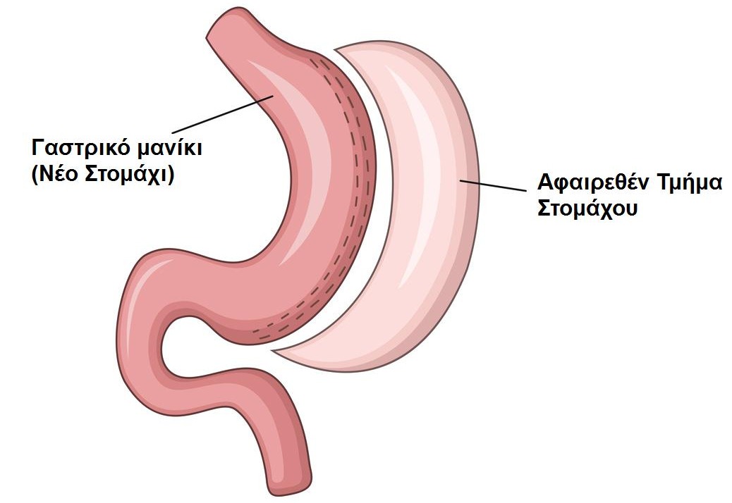 είναι αποτελεσματικό το γαστρικό μανίκι;