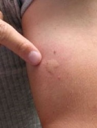 κουνούπι τσιμπάει φαγούρα πρήξιμο