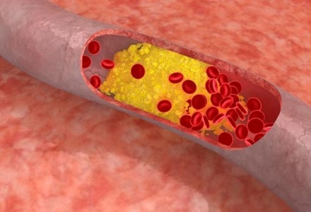 αρτηρία με αθηροσκλήρωση